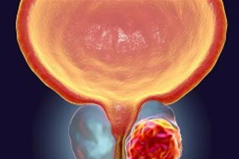 Câncer da próstata